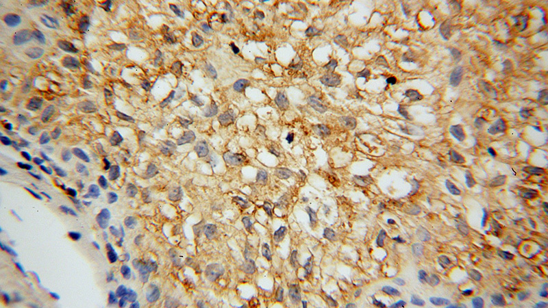 Immunohistochemical of paraffin-embedded human osteosarcoma using Catalog No:108883(SLC7A1 antibody) at dilution of 1:100 (under 40x lens)
