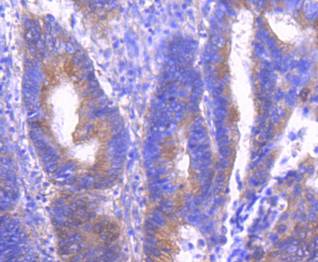 Fig5:; Immunohistochemical analysis of paraffin-embedded human colon carcinoma tissue using anti-Phospho-PAK1(S144)+PAK2(S141)+PAK3(S139) antibody. The section was pre-treated using heat mediated antigen retrieval with Tris-EDTA buffer (pH 8.0-8.4) for 20 minutes.The tissues were blocked in 5% BSA for 30 minutes at room temperature, washed with ddH; 2; O and PBS, and then probed with the primary antibody ( 1/50) for 30 minutes at room temperature. The detection was performed using an HRP conjugated compact polymer system. DAB was used as the chromogen. Tissues were counterstained with hematoxylin and mounted with DPX.
