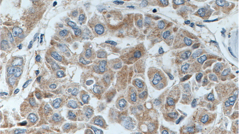 Immunohistochemistry of paraffin-embedded human liver cancer tissue slide using Catalog No:117100(BCL2L2 Antibody) at dilution of 1:200 (under 40x lens). heat mediated antigen retrieved with Tris-EDTA buffer(pH9).
