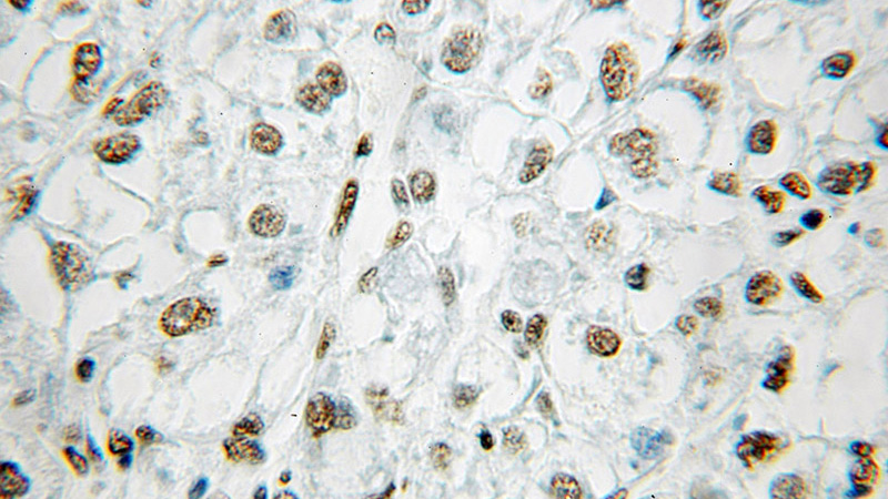 Immunohistochemical of paraffin-embedded human liver cancer using Catalog No:112367(MAD2L1 antibody) at dilution of 1:50 (under 25x lens)