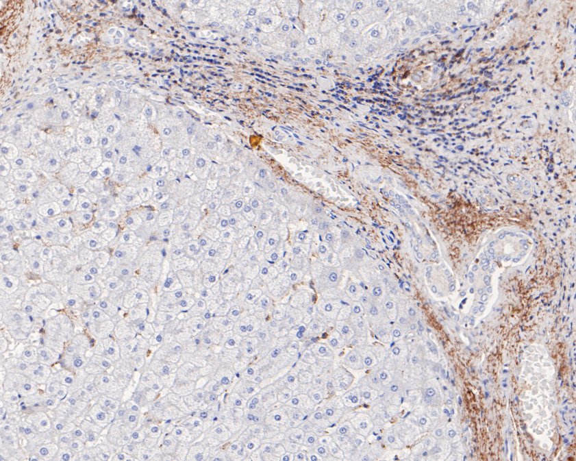 Fig6:; Immunohistochemical analysis of paraffin-embedded human liver tissue using anti-Vitronectin antibody. The section was pre-treated using heat mediated antigen retrieval with Tris-EDTA buffer (pH 8.0-8.4) for 20 minutes.The tissues were blocked in 5% BSA for 30 minutes at room temperature, washed with ddH; 2; O and PBS, and then probed with the primary antibody ( 1/50) for 30 minutes at room temperature. The detection was performed using an HRP conjugated compact polymer system. DAB was used as the chromogen. Tissues were counterstained with hematoxylin and mounted with DPX.