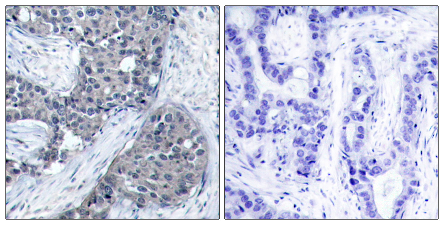 Immunohistochemical analysis of paraffin-embedded human breast carcinoma tissue using eIF4E (Phospho-Ser209) Antibody (left) or the same antibody preincubated with blocking peptide (right).