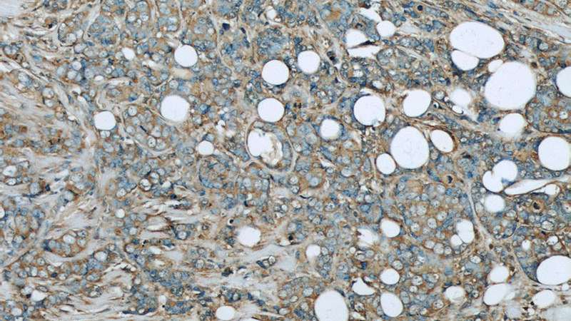 Immunohistochemistry of paraffin-embedded human breast cancer slide using Catalog No:107363(KNG1 Antibody) at dilution of 1:50