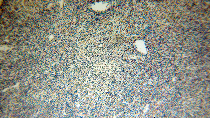 Immunohistochemical of paraffin-embedded human lymphoma using Catalog No:113303(NOP2 antibody) at dilution of 1:50 (under 10x lens)