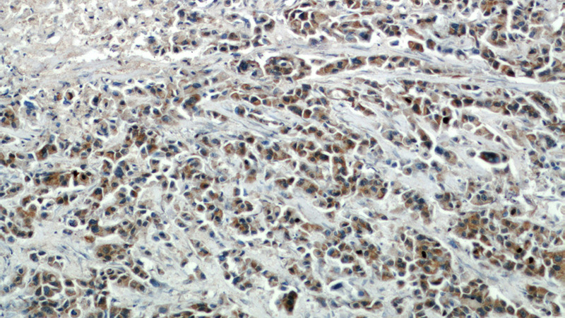 Immunohistochemical of paraffin-embedded human breast cancer using Catalog No:117262(ZP3 antibody) at dilution of 1:50 (under 10x lens)