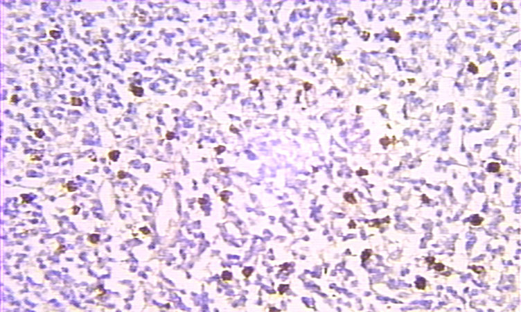 Immunohistochemical of paraffin-embedded human lymphoma using Catalog No:114223(PTMA antibody) at dilution of 1:100 (under 25x lens)