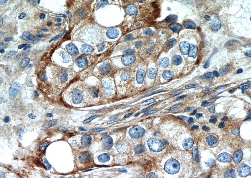 Immunohistochemistry of paraffin-embedded human breast cancer slide using Catalog No:111623(IFITM2 Antibody) at dilution of 1:50
