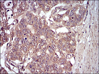 Immunohistochemical analysis of paraffin-embedded esophageal cancer tissues using GAB2 mouse mAb with DAB staining.