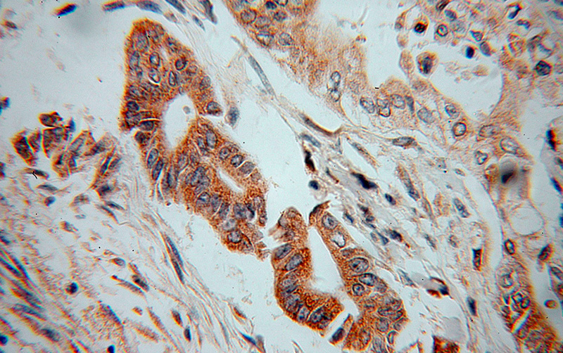 Immunohistochemical of paraffin-embedded human pancreas cancer using Catalog No:116554(UGCGL1 antibody) at dilution of 1:100 (under 40x lens)