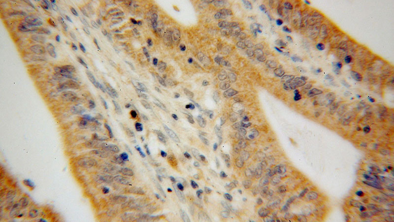 Immunohistochemical of paraffin-embedded human colon cancer using Catalog No:112409(LYPLA1 antibody) at dilution of 1:100 (under 40x lens)
