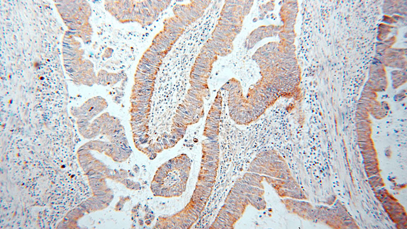 Immunohistochemical of paraffin-embedded human colon cancer using Catalog No:114441(RAB3B antibody) at dilution of 1:50 (under 10x lens)