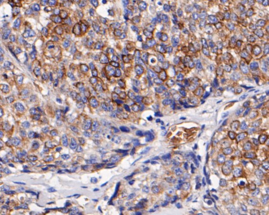 Fig6: Immunohistochemical analysis of paraffin-embedded human lung carcinoma tissue using anti-CD68 antibody. The section was pre-treated using heat mediated antigen retrieval with Tris-EDTA buffer (pH 8.0-8.4) for 20 minutes.The tissues were blocked in 5% BSA for 30 minutes at room temperature, washed with ddH2O and PBS, and then probed with the primary antibody ( 1/50) for 30 minutes at room temperature. The detection was performed using an HRP conjugated compact polymer system. DAB was used as the chromogen. Tissues were counterstained with hematoxylin and mounted with DPX.