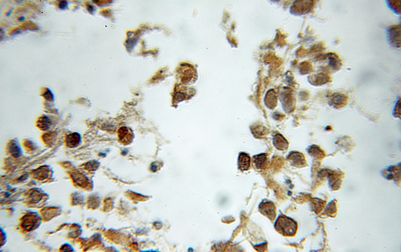 Immunohistochemical of paraffin-embedded human gliomas using Catalog No:113400(NTHL1 antibody) at dilution of 1:50 (under 10x lens)