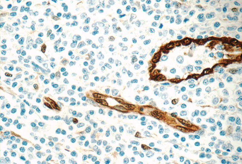 Immunohistochemistry of paraffin-embedded human tonsillitis tissue slide using Catalog No:108957(CCBP2 Antibody) at dilution of 1:1200 (under 40x lens)
