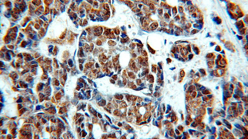 Immunohistochemical of paraffin-embedded human cervical cancer using Catalog No:116248(TOP2B antibody) at dilution of 1:100 (under 40x lens)