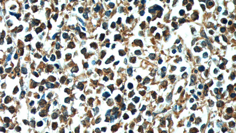Immunohistochemistry of paraffin-embedded human lymphoma tissue slide using Catalog No:107073(AURKB Antibody) at dilution of 1:200 (under 40x lens). heat mediated antigen retrieved with Tris-EDTA buffer(pH9).