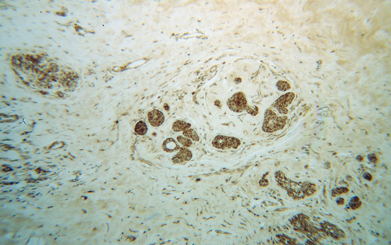 Immunohistochemical of paraffin-embedded human breast cancer using Catalog No:113762(PDAP1 antibody) at dilution of 1:50 (under 10x lens)