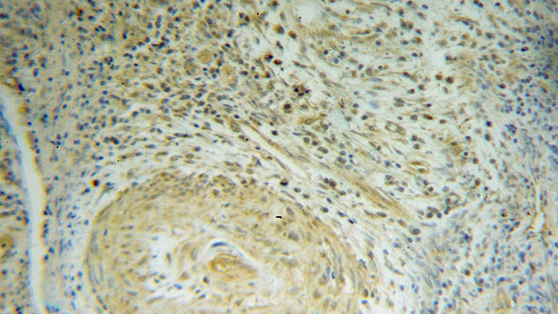 Immunohistochemical of paraffin-embedded human cervical cancer using Catalog No:109608(CSRP1 antibody) at dilution of 1:100 (under 10x lens)