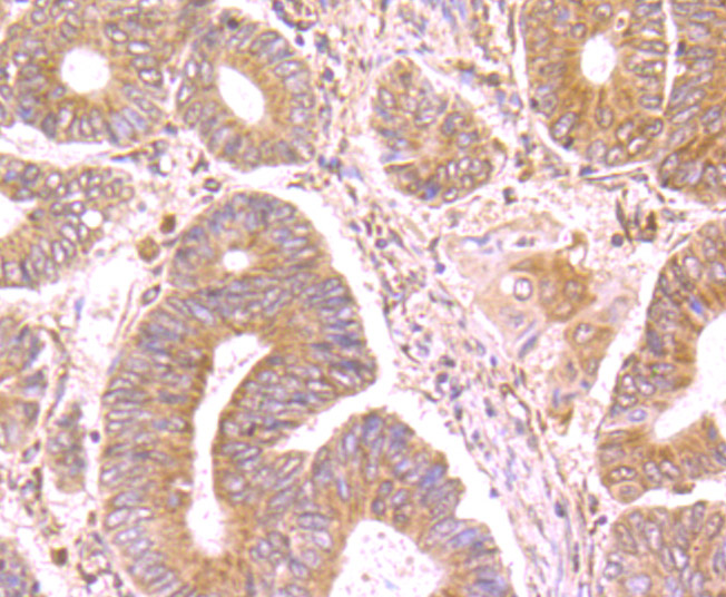 Fig5: Immunohistochemical analysis of paraffin-embedded human colon cancer tissue using anti-SFRP1 antibody. Counter stained with hematoxylin.