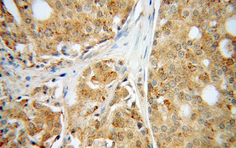 Immunohistochemical of paraffin-embedded human prostate cancer using Catalog No:111302(HEXA antibody) at dilution of 1:50 (under 40x lens)