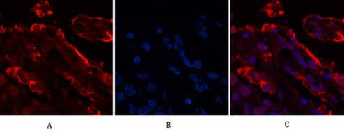 Immunofluorescence analysis of Human-lung-cancer tissue. 1,Galectin-3 Monoclonal Antibody(6G2)(red) was diluted at 1:200(4°C,overnight). 2, Cy3 labled Secondary antibody was diluted at 1:300(room temperature, 50min).3, Picture B: DAPI(blue) 10min. Picture A:Target. Picture B: DAPI. Picture C: merge of A+B
