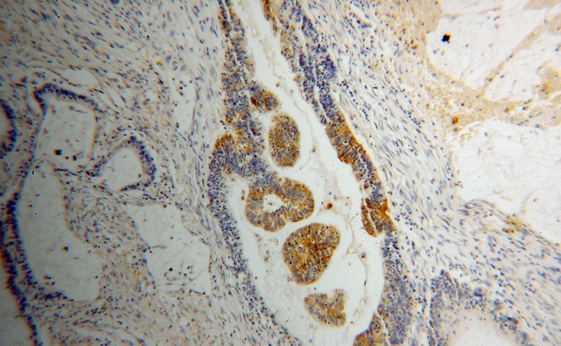 Immunohistochemical of paraffin-embedded human colon cancer using Catalog No:114695(RIBC2 antibody) at dilution of 1:50 (under 10x lens)