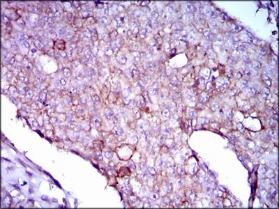 Fig4: Immunohistochemical analysis of paraffin-embedded human breast cancer tissue using anti- Lipoprotein a antibody. Counter stained with hematoxylin.