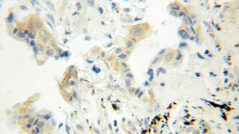 Immunohistochemical of paraffin-embedded human lung cancer using Catalog No:110607(SQS antibody) at dilution of 1:100 (under 40x lens)