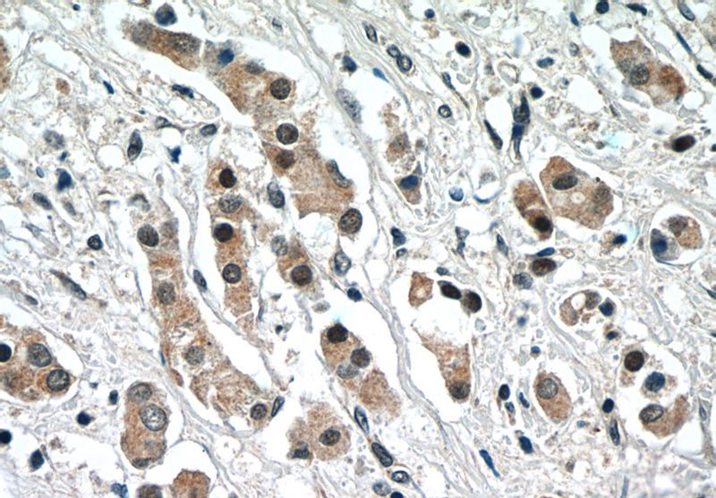 Immunohistochemistry of paraffin-embedded human breast cancer tissue slide using Catalog No:113277(NRF2, NFE2L2 Antibody) at dilution of 1:50 (under 40x lens)