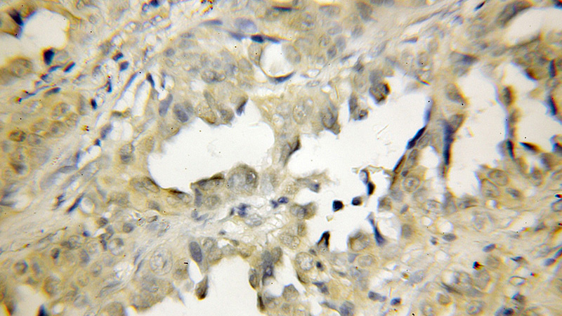 Immunohistochemical of paraffin-embedded human lung cancer using Catalog No:113707(PEPD antibody) at dilution of 1:50 (under 10x lens)