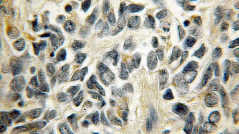 Immunohistochemical of paraffin-embedded human medulloblastoma using Catalog No:115800(STX7 antibody) at dilution of 1:50 (under 10x lens)