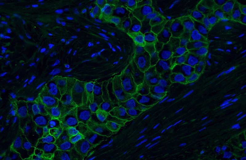 Immunofluorescent analysis of (4% PFA) fixed human breast cancer tissue using Catalog No:107244 (E-cadherin Antibody) at dilution of 1:250 and Alexa Fluor 488-congugated AffiniPure Goat Anti-Mouse IgG(H+L)