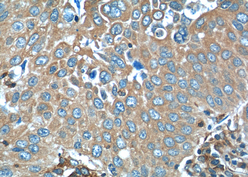 Immunohistochemistry of paraffin-embedded human lung cancer tissue slide using Catalog No:114922(RRBP1 Antibody) at dilution of 1:50 (under 40x lens)