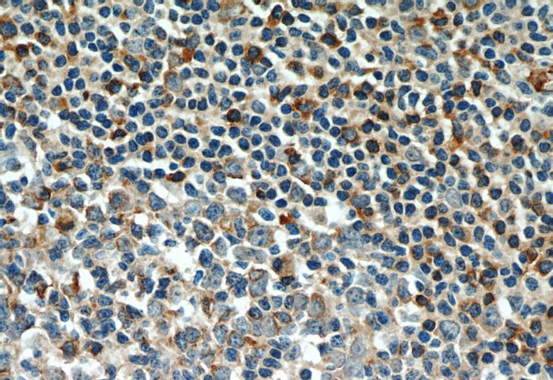 Immunohistochemistry of paraffin-embedded human tonsillitis tissue slide using Catalog No:111859(Integrin alpha-4 Antibody) at dilution of 1:50