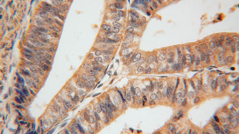 Immunohistochemical of paraffin-embedded human endometrial cancer using Catalog No:115203(SERPINB2 antibody) at dilution of 1:50 (under 40x lens)