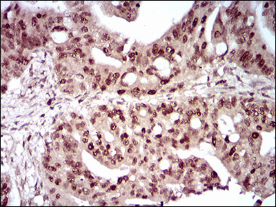 Immunohistochemical analysis of paraffin-embedded rectum cancer tissues using DAPK3 mouse mAb with DAB staining.