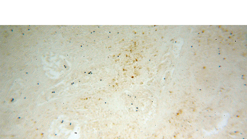 Immunohistochemical of paraffin-embedded human osteosarcoma using Catalog No:117146(BIN1 antibody) at dilution of 1:100 (under 10x lens)