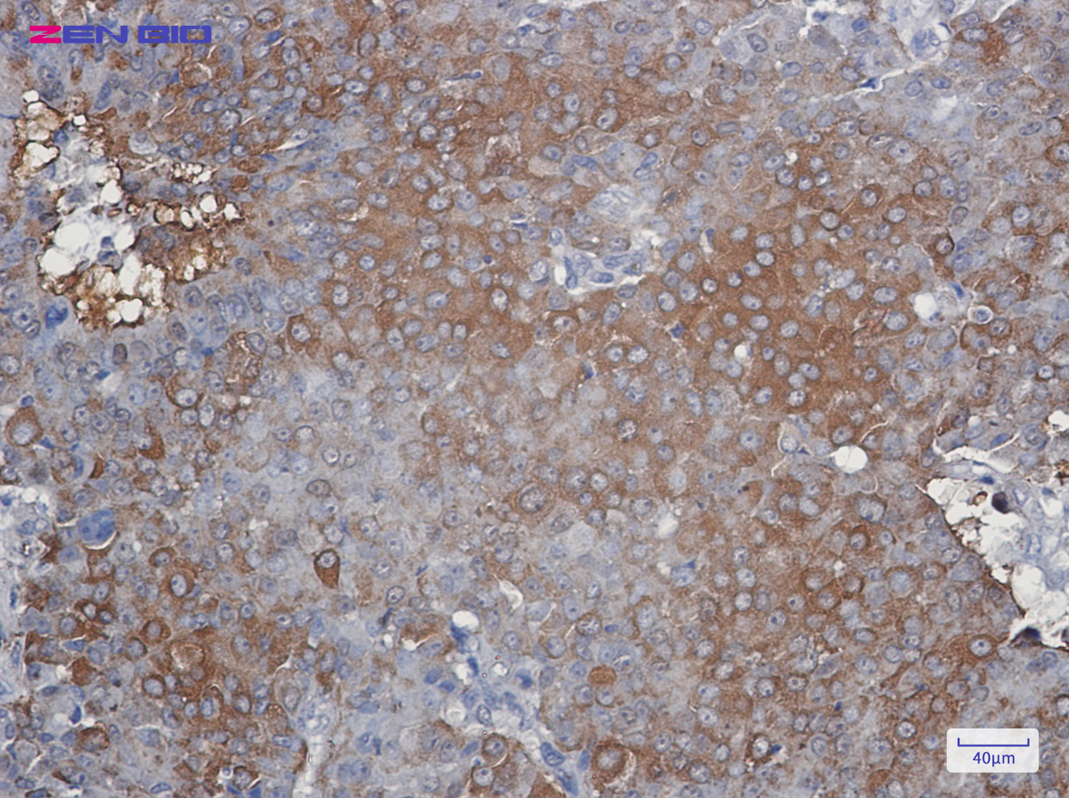 Immunohistochemistry of Peroxiredoxin 2 in paraffin-embedded Human breast cancer tissue using Peroxiredoxin 2 Rabbit pAb at dilution 1/50