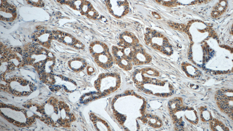 Immunohistochemistry of paraffin-embedded human breast cancer tissue slide using Catalog No:107629(TNF-a Antibody) at dilution of 1:50 (under 10x lens)