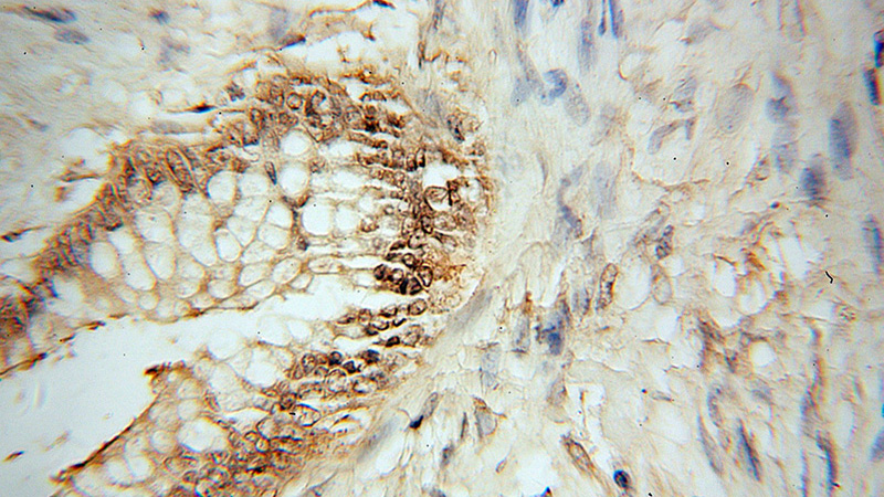 Immunohistochemical of paraffin-embedded human colon cancer using Catalog No:111476(HMG20B antibody) at dilution of 1:50 (under 40x lens)