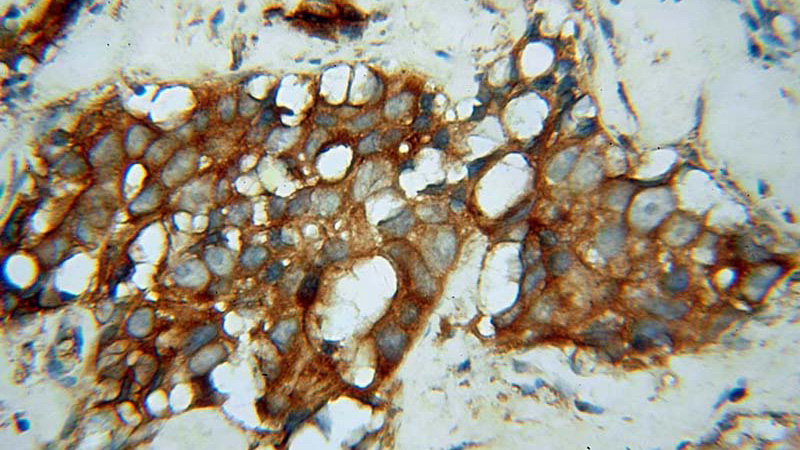 Immunohistochemical of paraffin-embedded human prostate cancer using Catalog No:113529(OXSR1 antibody) at dilution of 1:100 (under 40x lens)