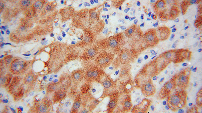 Immunohistochemical of paraffin-embedded human liver cancer using Catalog No:111467(UK114; HRSP12 antibody) at dilution of 1:100 (under 40x lens)