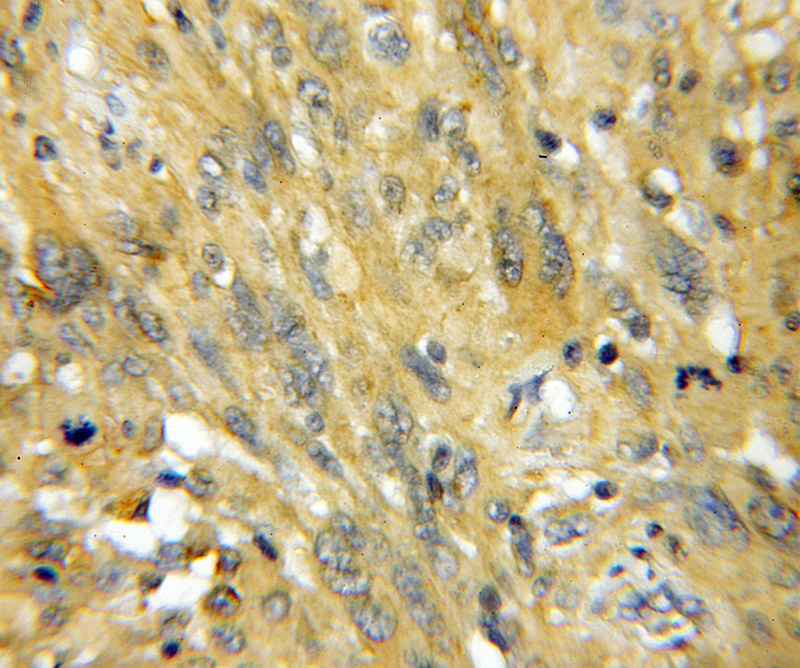 Immunohistochemical of paraffin-embedded human gliomas using Catalog No:108770(CACYBP antibody) at dilution of 1:50 (under 10x lens)
