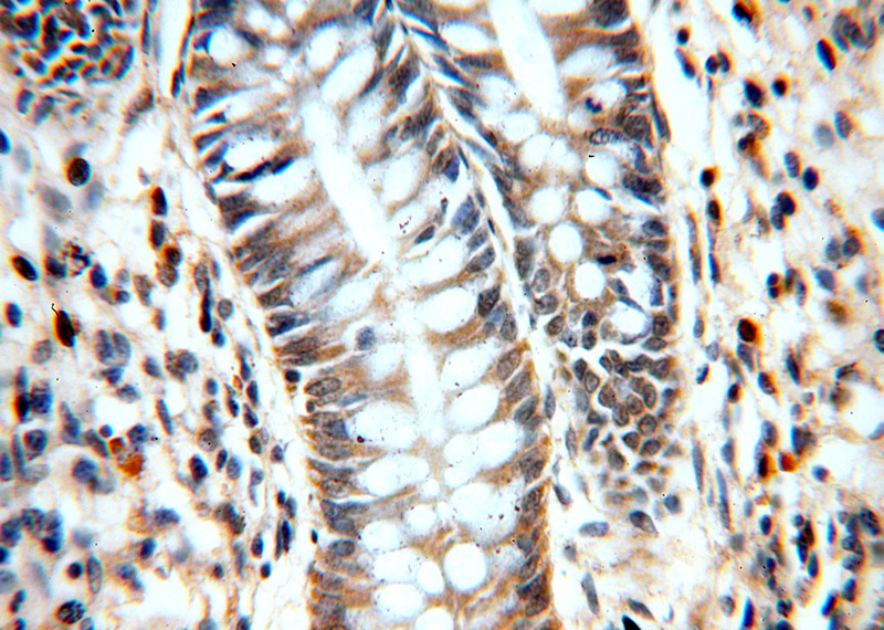 Immunohistochemical of paraffin-embedded human colon using Catalog No:108638(C11orf49 antibody) at dilution of 1:50 (under 40x lens)