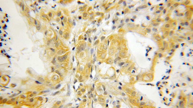 Immunohistochemical of paraffin-embedded human pancreas cancer using Catalog No:114448(RABIN8 antibody) at dilution of 1:50 (under 10x lens)