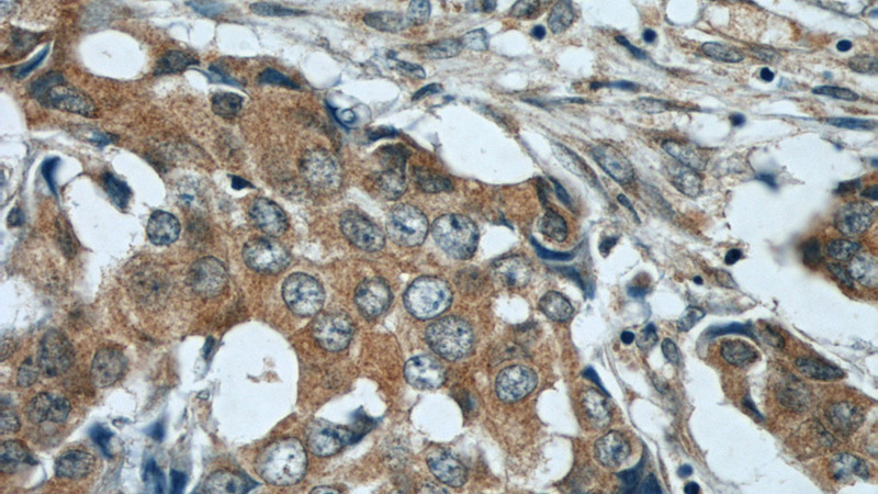Immunohistochemical of paraffin-embedded human breast cancer using Catalog No:107899(AEG-1 antibody) at dilution of 1:50 (under 40x lens)