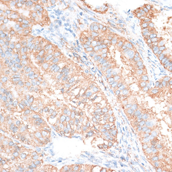 Immunohistochemistry - HMGA2 Polyclonal Antibody 