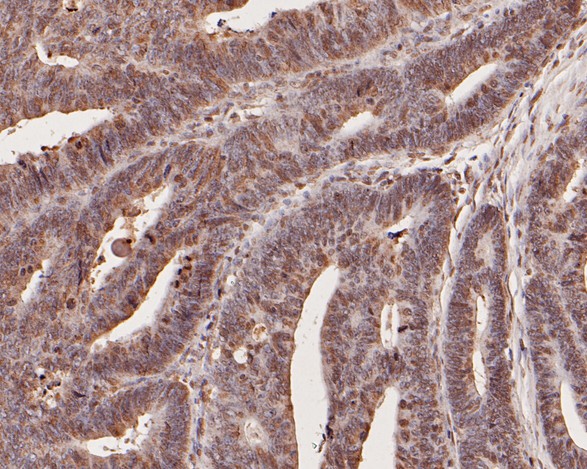 Fig3:; Immunohistochemical analysis of paraffin-embedded human colon carcinoma tissue using anti-CCL2/MCP1 antibody. The section was pre-treated using heat mediated antigen retrieval with Tris-EDTA buffer (pH 8.0-8.4) for 20 minutes.The tissues were blocked in 5% BSA for 30 minutes at room temperature, washed with ddH; 2; O and PBS, and then probed with the primary antibody ( 1/200) for 30 minutes at room temperature. The detection was performed using an HRP conjugated compact polymer system. DAB was used as the chromogen. Tissues were counterstained with hematoxylin and mounted with DPX.