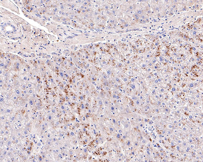 Fig4:; Immunohistochemical analysis of paraffin-embedded human liver tissue using anti-Factor H antibody. The section was pre-treated using heat mediated antigen retrieval with Tris-EDTA buffer (pH 8.0-8.4) for 20 minutes.The tissues were blocked in 5% BSA for 30 minutes at room temperature, washed with ddH; 2; O and PBS, and then probed with the primary antibody ( 1/100) for 30 minutes at room temperature. The detection was performed using an HRP conjugated compact polymer system. DAB was used as the chromogen. Tissues were counterstained with hematoxylin and mounted with DPX.
