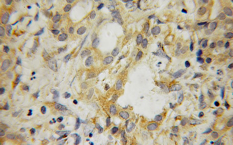 Immunohistochemical of paraffin-embedded human pancreas cancer using Catalog No:115584(SRFBP1 antibody) at dilution of 1:100 (under 10x lens)